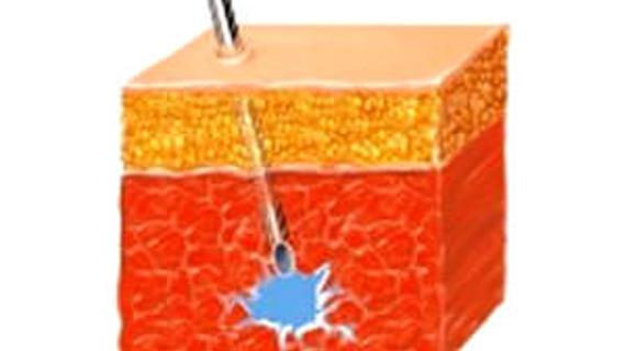 Превью картинка статьи Инфильтративные изменения в легких что это