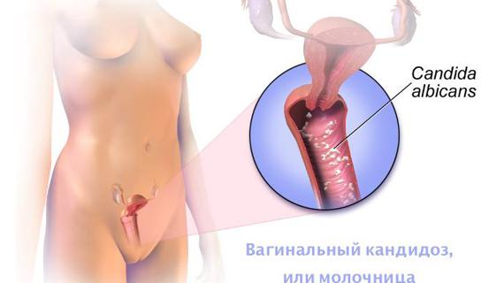 Превью картинка статьи Почему появляется молочница во второй фазе цикла