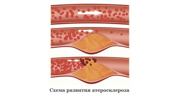 Превью картинка статьи Атеросклероз коронарных артерий: описание и методы лечения