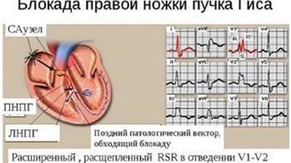 Превью картинка статьи Можно ли заниматься спортом при блокаде левого пучка гиса