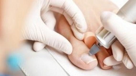 Превью картинка статьи Медицинский педикюр при грибке ногтей: что это такое, как и где делается