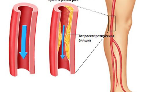 Превью картинка статьи Боль в ногах и коленях при депрессии