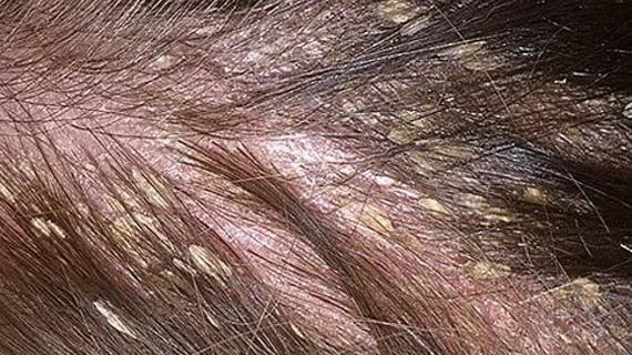 Превью картинка статьи Себорея на коже головы: причины, симптомы, фото, лечение