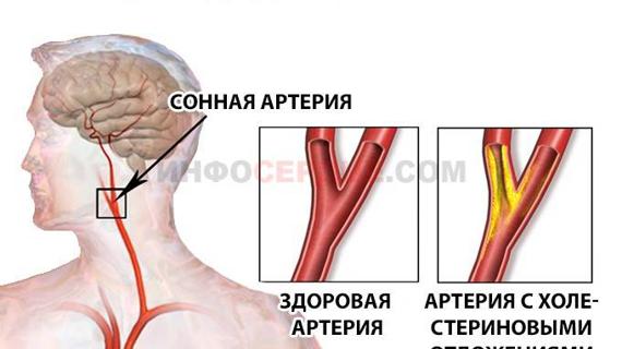 70 сонная артерия забита