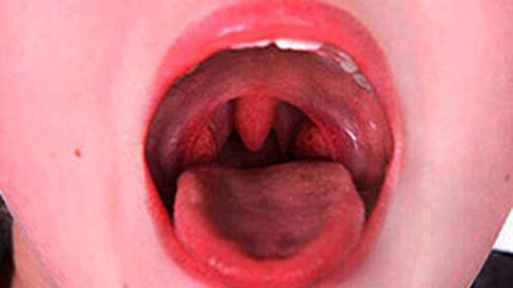 Превью картинка статьи Как отличить ангину от фарингита - в чем разница 2021