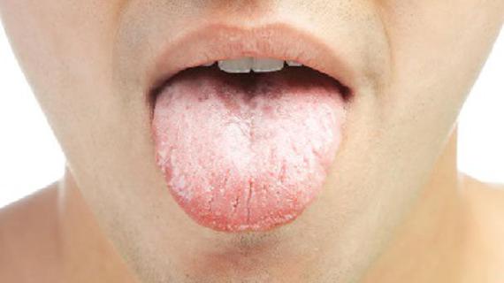 Превью картинка статьи Симптомы похожие на молочницу но не молочница у мужчин