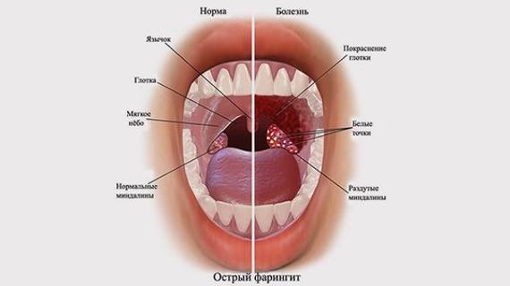 Превью картинка статьи Белые точки в горле - как лечить, о какой болезни говорят