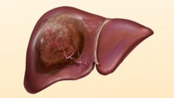 Превью картинка статьи Фиброз печени 2 степени - лечение и прогноз