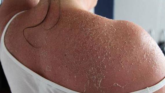 Превью картинка статьи Шелушение кожи (вокруг рта, на бровях и носу): что делать, почему шелушится