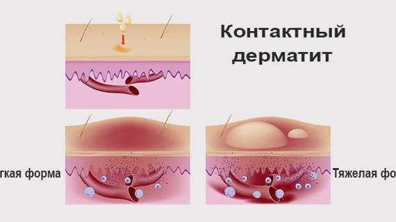 Превью картинка статьи Дерматит сколько лечится — Аллергия