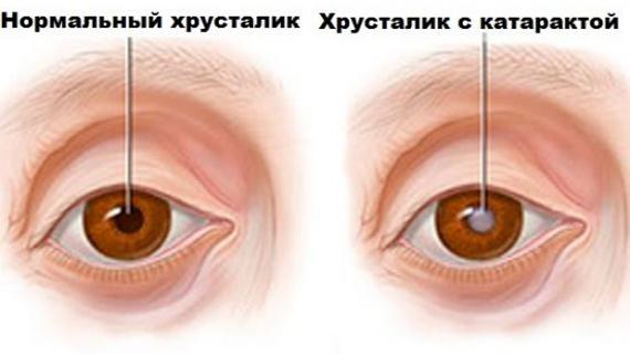 Превью картинка статьи Операция по удалению катаракты: отзывы, последствия замены хрусталика, осложнения и противопоказания