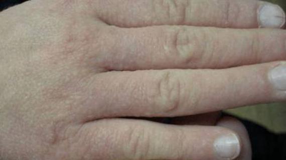Превью картинка статьи Прыщи на руках: почему они появляются на пальцах, причины, лечение