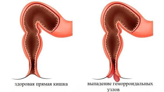 Превью картинка статьи Избавиться от геморроя раз и навсегда народными средствами и в домашних условиях, вылечить шишки и геморроидальные узлы