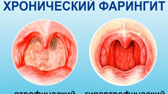 Превью картинка статьи Гипертрофический фарингит - симптомы и лечение взрослых и детей 2021