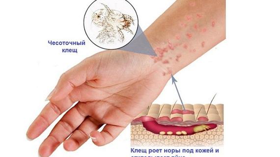 Превью картинка статьи Вши подкожные у человека: фото симптомов вшей под кожей на теле