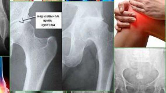 Превью картинка статьи Остеосклеротический очаг что это рак