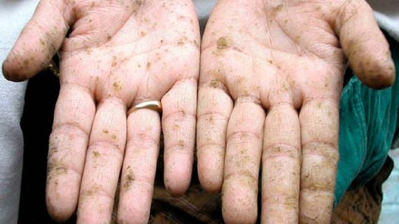 Превью картинка статьи Можно ли отравиться запахом протухшего мяса