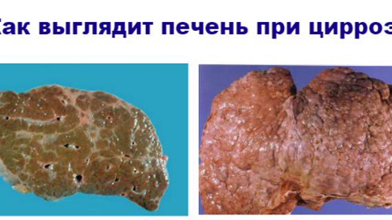 Превью картинка статьи Разложение печени при циррозе: можно ли вылечиться и какова продолжительность жизни