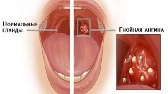 Превью картинка статьи Гнойная ангина без температуры – может ли она так протекать 2021