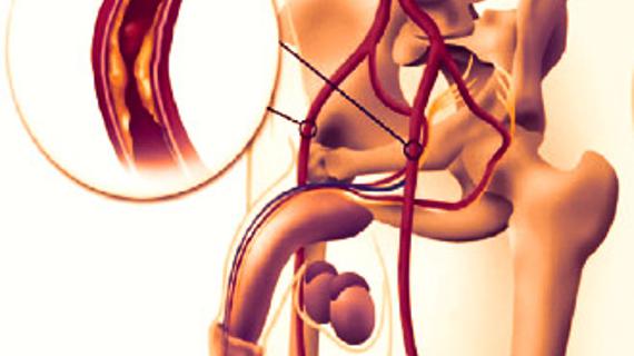 Превью картинка статьи Эрекция при массаже простаты: если появляется семяизвержение 2021