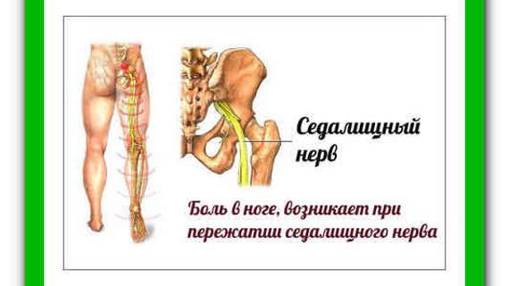 Превью картинка статьи Лечение защемления седалищного нерва в домашних условиях