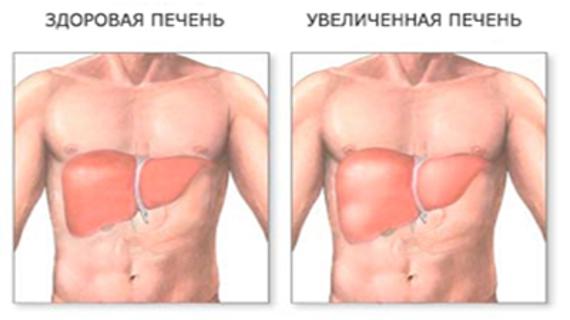 Превью картинка статьи Размеры печени в норме и увеличенные