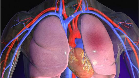 Превью картинка статьи Пеногасители при отеке легких