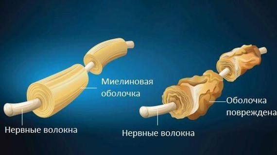 Превью картинка статьи Единичные очаги демиелинизации в лобных долях — Про сосуды