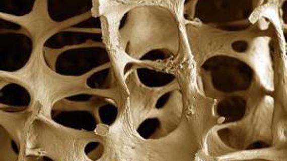 Превью картинка статьи Разрежение костной ткани — Суставы