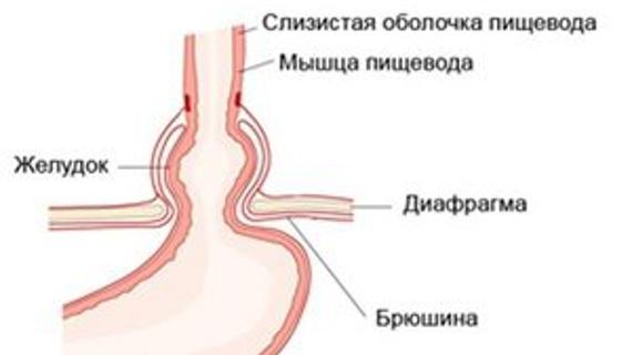Превью картинка статьи Аксиальная грыжа пищеводного отверстия диафрагмы (ГПОД) 1, 2 степени:  что это такое, классификация, симптомы и лечение