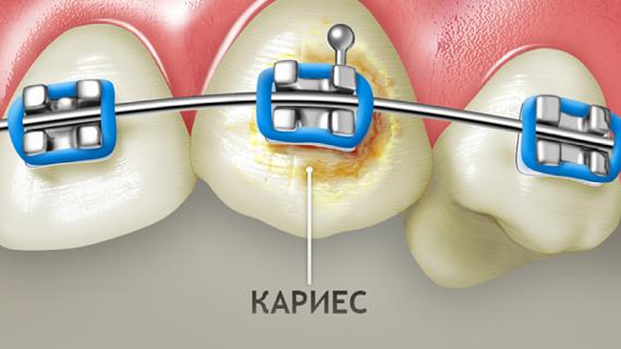 Превью картинка статьи Прыщи из за брекетов