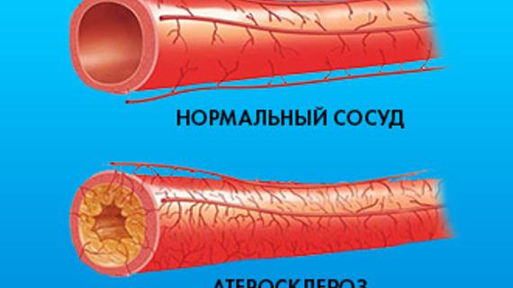 Превью картинка статьи Мультифокальный атеросклероз: симптомы и лечение