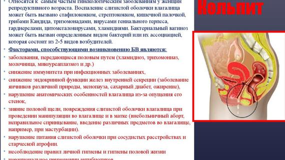 Превью картинка статьи Я вылечила неспецифический вагинит за