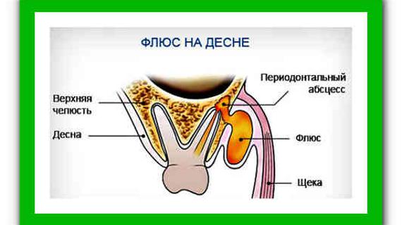 Превью картинка статьи Зубной флюс лечение в домашних условиях