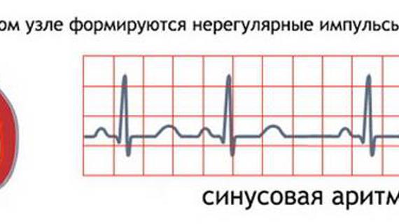 Нерегулярность ритма сердца процентах. Нерегулярность ритма сердца норма в процентах. Нормосистолия. Нормосистолия это сколько.