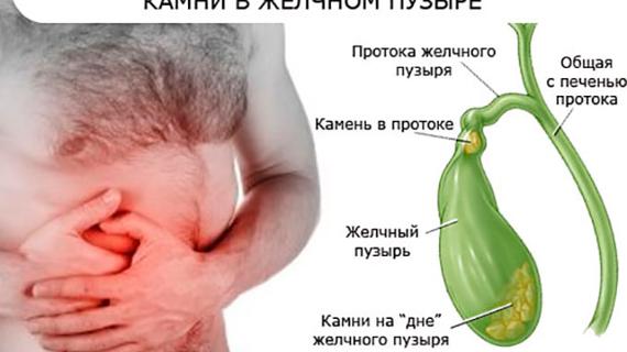 Превью картинка статьи Может ли от полисорба быть белый кал