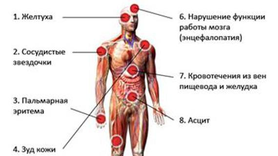 Превью картинка статьи Признаки цирроза — Все о печени
