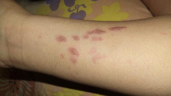 Превью картинка статьи Чем лечить старые рубцы от ожогов