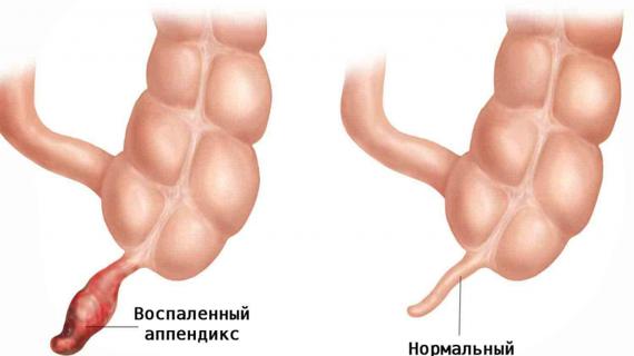 Превью картинка статьи Почему после операции аппендицита ставят трубку