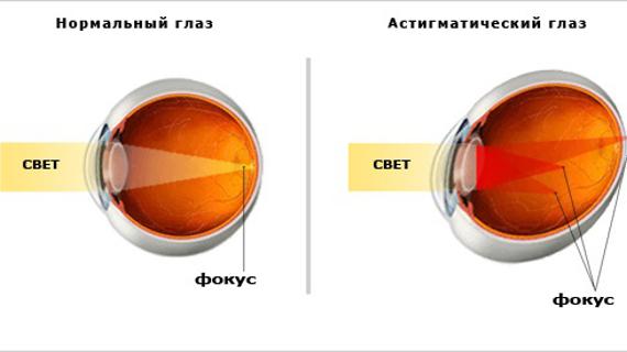Превью картинка статьи Астигматизм: что это за болезнь, причины, лечение