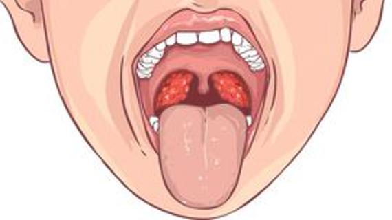 Превью картинка статьи Тонзиллит - что это такое, виды, симптомы, причины появления и лечение