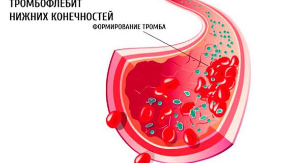Превью картинка статьи Лечение тромбофлебита: что такое тромбофлебит его признаки и симптомы и как его лечить