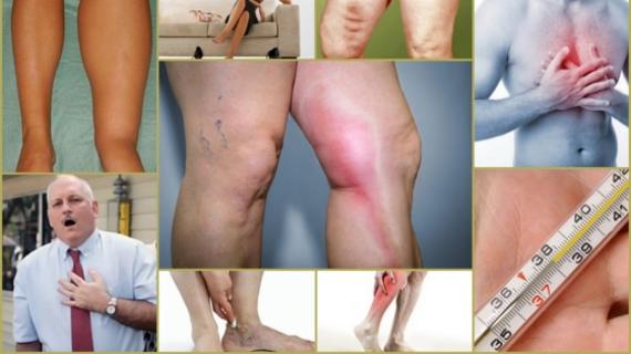 Превью картинка статьи Последствия после тромбоза глубоких вен