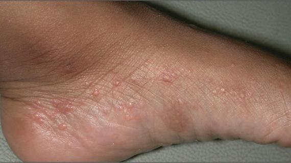 Превью картинка статьи Мокнущая экзема на ногах как лечить в домашних условиях быстро