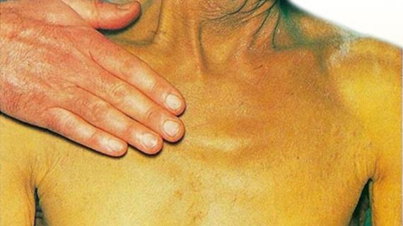 Превью картинка статьи Механическая желтуха: причины, симптомы и лечение