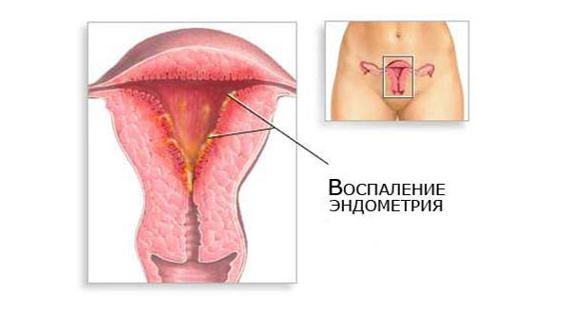 Превью картинка статьи Хронический эндометрит: что это такое и как лечить, отзывы
