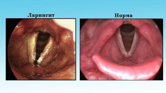 Превью картинка статьи Ларингит у грудничка - симптомы и лечение детей до года 2021