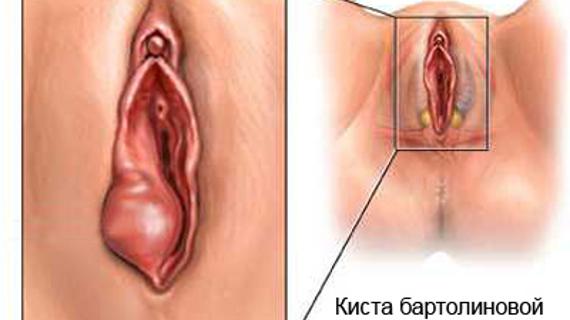 Превью картинка статьи В интимном месте появилась шишка в виде шарика - фото, причины, лечение