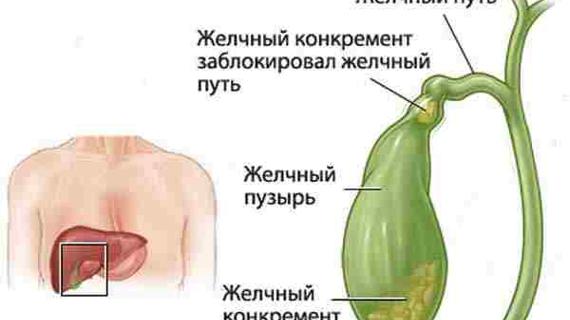 Превью картинка статьи Гиперэхогенные образования в желчном пузыре: причины, виды, УЗИ диагностика
