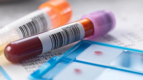 Превью картинка статьи гормон щитовидной железы ат тпо повышен что это значит